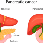 Pancreatic Cancer- Pankaj Udas Death-Chordoma