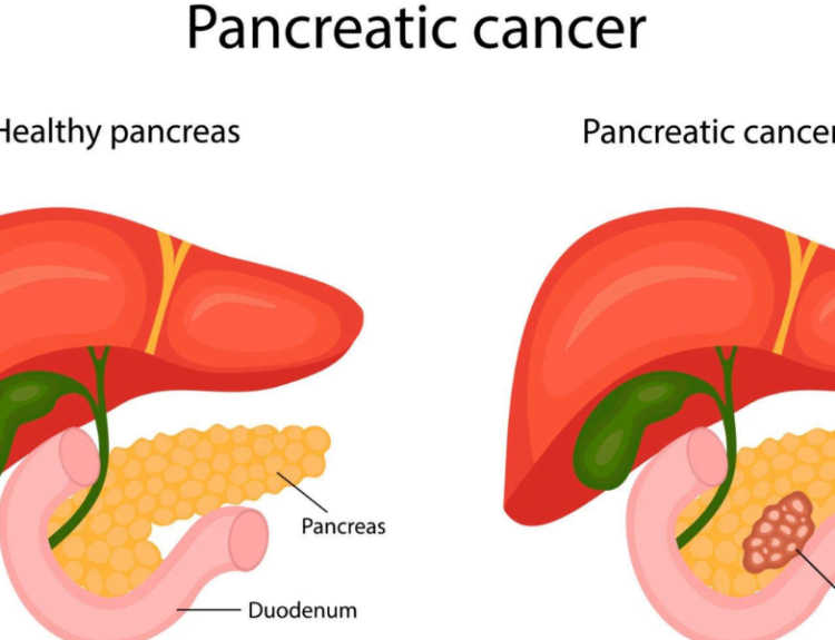 Pancreatic Cancer- Pankaj Udas Death-Chordoma