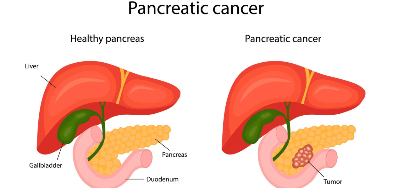 Pancreatic Cancer- Pankaj Udas Death-Chordoma